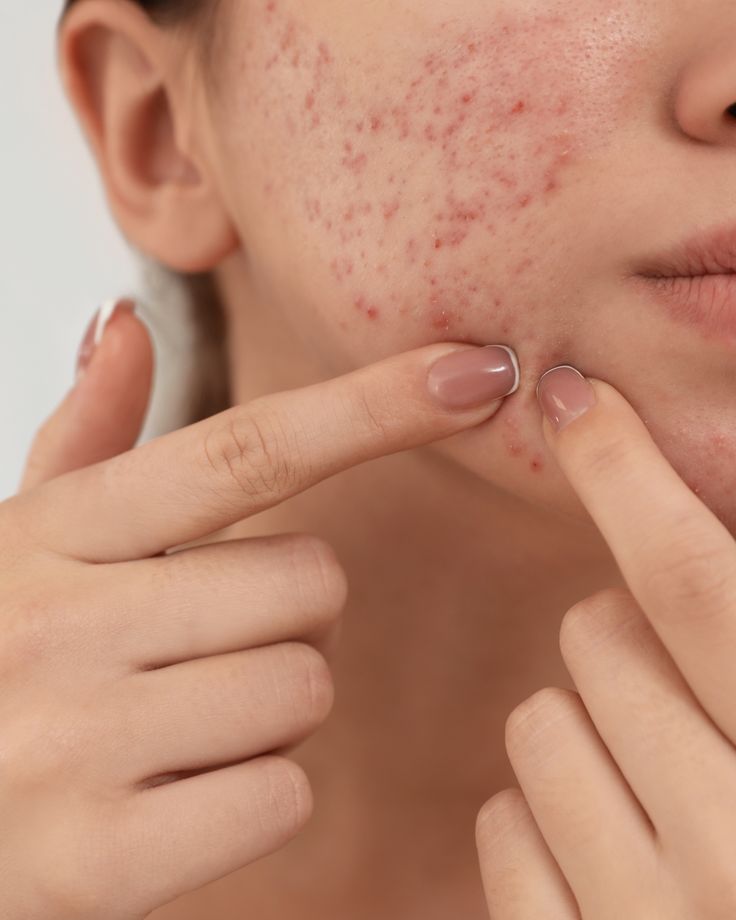 a girl showing her post-acne marks