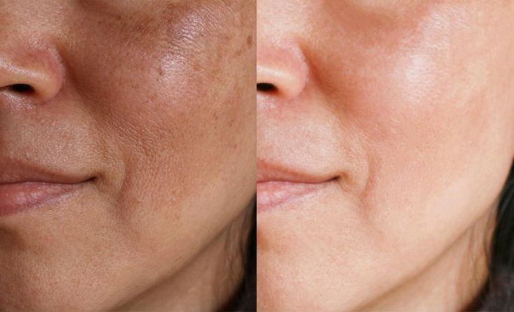 Mineral vs Chemical Sunscreen for Acne Prone Skin