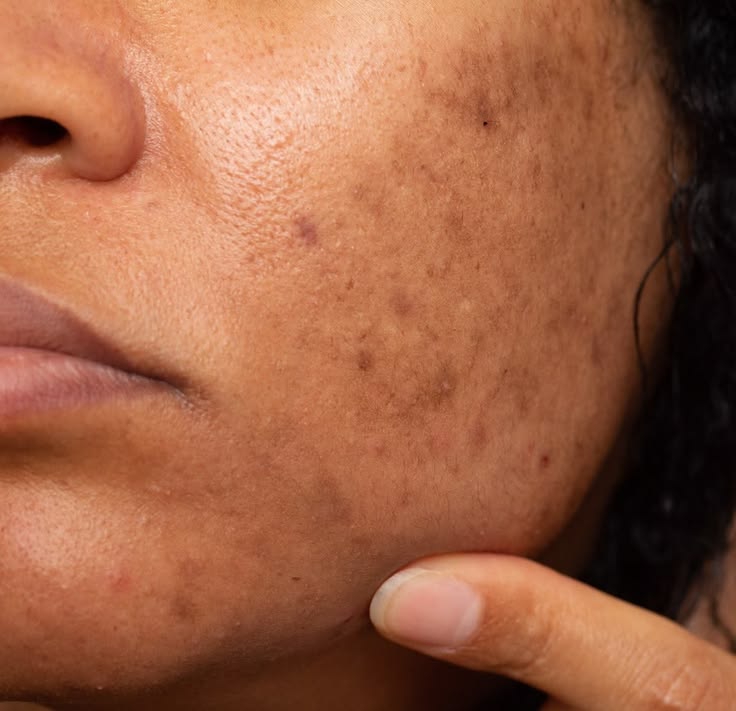 Niacinamide is Perfect for Indian Skin