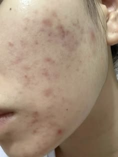 Acne Marks vs Acne Scars
