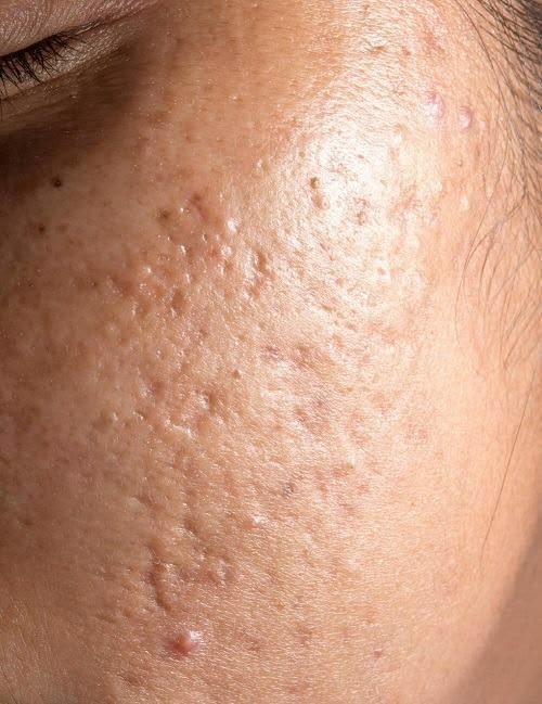 Acne Marks vs Acne Scars